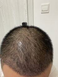 体验后-大麦微针植发全国连锁
