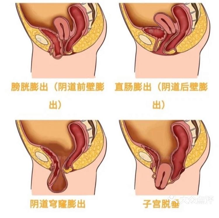 产后直肠膨出图图片