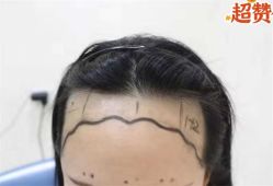 -大麦微针植发全国连锁