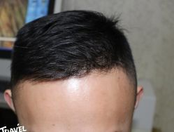 -大麦微针植发丨全国连锁