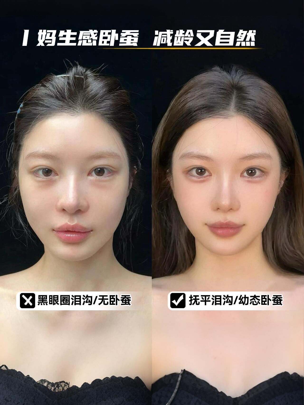 卧蚕填充对比|一眼美女的关键73