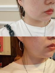 体验前-深圳春天阳光医院·轮廓抗衰中心