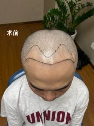 -大麦微针植发全国连锁