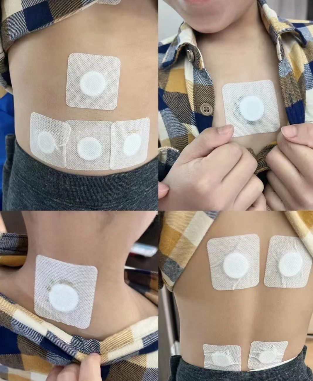 生长贴是将特制的中药膏贴于相应的穴位,通