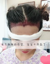 -大麦微针植发全国连锁