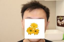 -大麦微针植发丨全国连锁