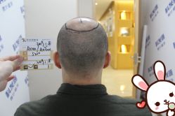 -大麦微针植发丨全国连锁