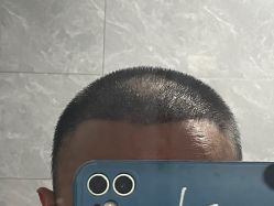 -大麦微针植发丨全国连锁