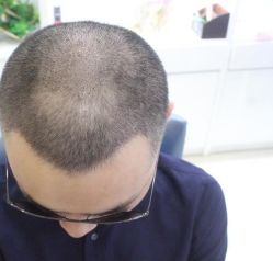 -大麦微针植发丨全国连锁