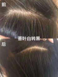 -菩叶脱发白发中心