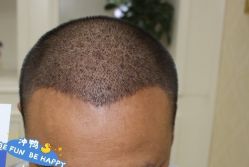 -大麦微针植发丨全国连锁