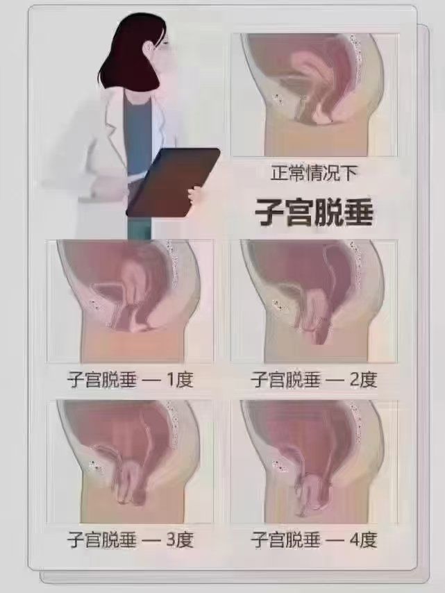 子宫脱垂在已育人群中,越来越年轻化,普遍化, 生过娃的,同房后小肚子