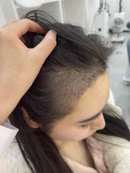 -大麦微针植发全国连锁