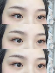 -U-Nail