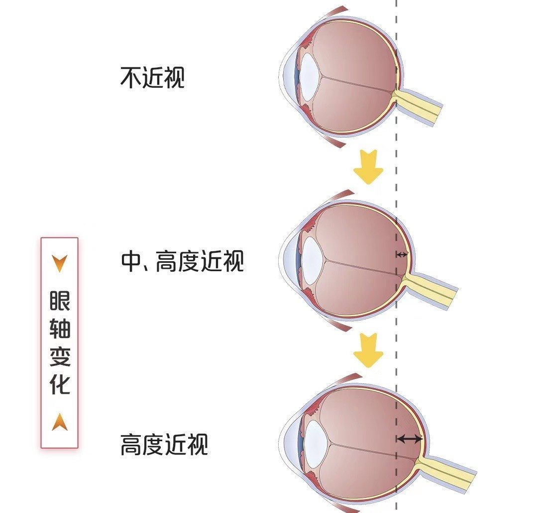 轴性近视人群每增长300度,眼轴增长1mm,简单来说,眼球凸出是度数增长