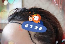 -大麦微针植发全国连锁