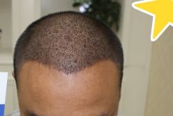 -大麦微针植发丨全国连锁