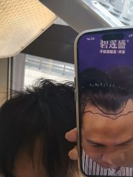 -碧莲盛·不剃发植发