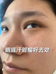 -美丽人生祛斑扁平疣汗管瘤中心