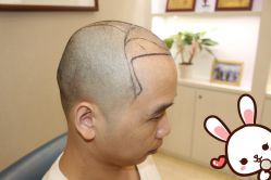 -大麦微针植发丨全国连锁