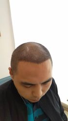 点击看大图 -大麦微针植发丨全国连锁