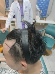 -碧莲盛不剃发植发