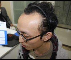 -大麦微针植发全国连锁