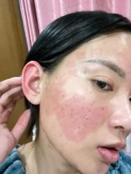 点击看大图 体验后-青岛诺德医学美容医院