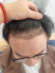 -大麦微针植发丨全国连锁