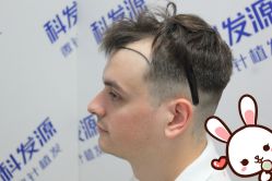 点击看大图 -大麦微针植发丨全国连锁