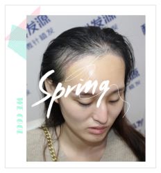 -大麦微针植发全国连锁