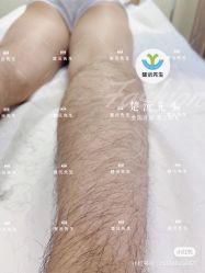 -楚沅先生专业男士脱毛连锁