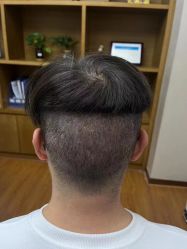 -大麦微针植发全国连锁