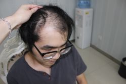 -大麦微针植发丨全国连锁