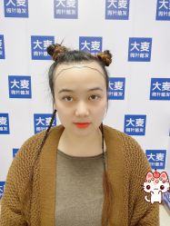 -大麦微针植发丨全国连锁