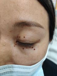 -北京美痣堂古方祛痣斑疣瘊