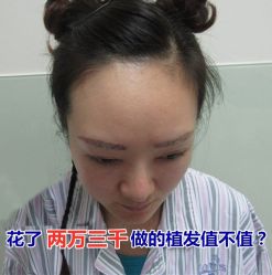 -碧莲盛·不剃发植发