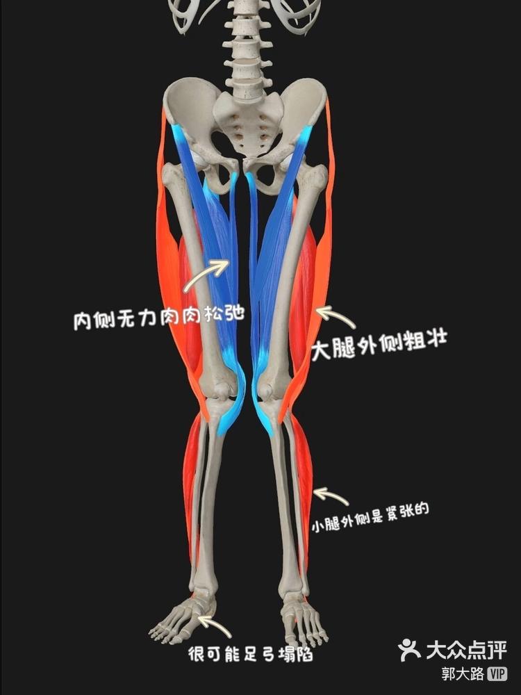 xo型腿x光片图片