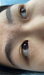 体验前-爱莎扁平疣·汗管瘤·斑痣中心