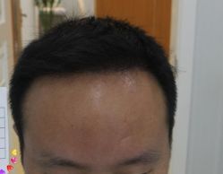 -大麦微针植发丨全国连锁