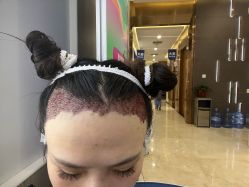 -大麦微针植发全国连锁