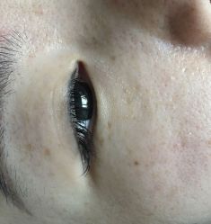 -爱莎扁平疣·汗管瘤·斑痣中心
