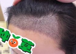 -大麦微针植发丨全国连锁