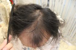 点击看大图 -大麦微针植发丨全国连锁