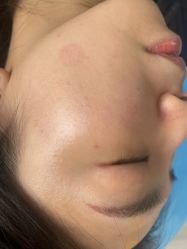 体验后-爱莎扁平疣·汗管瘤·斑痣中心