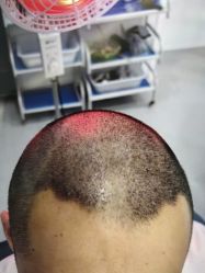 体验后-大麦微针植发全国连锁