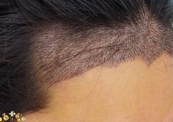 -大麦微针植发丨全国连锁