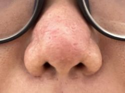 体验后-KS科逆美肤祛痘