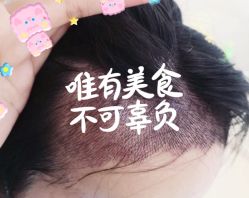 -大麦微针植发全国连锁