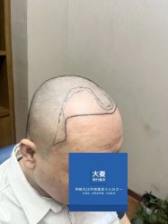 -大麦微针植发全国连锁